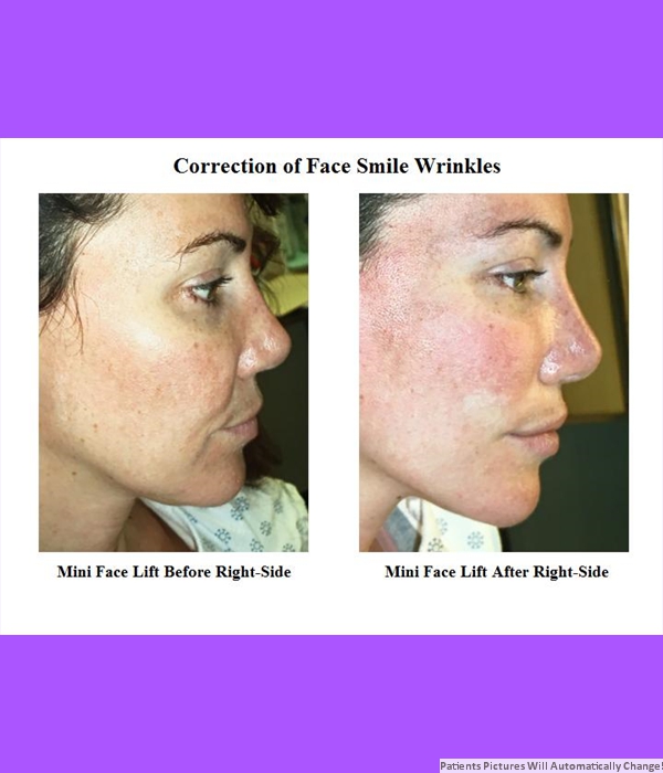 Correction of Face Smile Wrinkles, Mini-Facelift, Right Side View Cost is 3,200.00