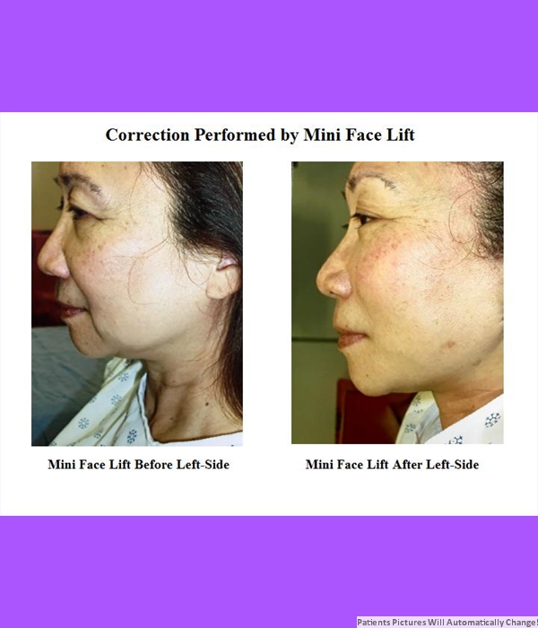 Correction Performed By Mini Face Lift, Left Side View Cost is $3,200.00