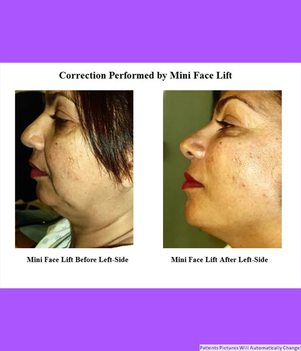 Correction Performed By Mini Face Lift Left Side View Cost is $3,200.00