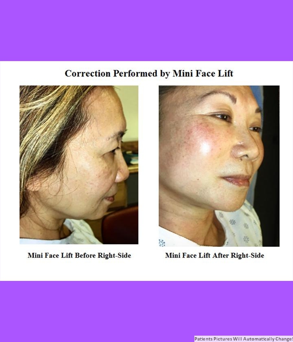Correction Performed By Mini Face Lift, Right Side View Cost is $3,200.00