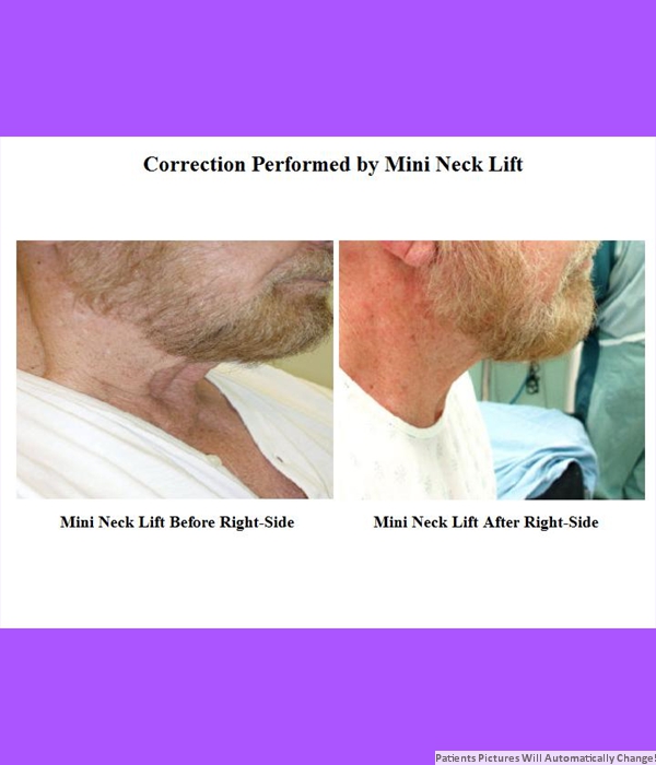 Correction Performed By Mini-Neck Lift Right, Side View Cost is $3200.00