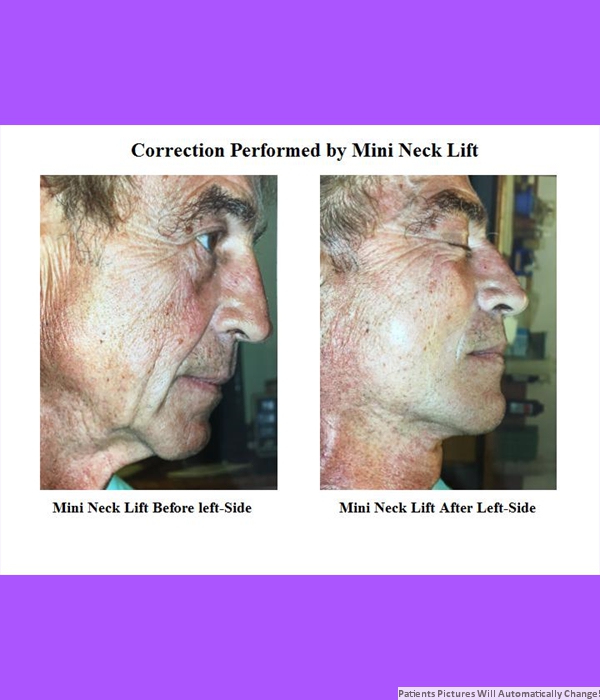 Correction Performed By Mini-Neck Lift, Right Side View Cost is $3200.00