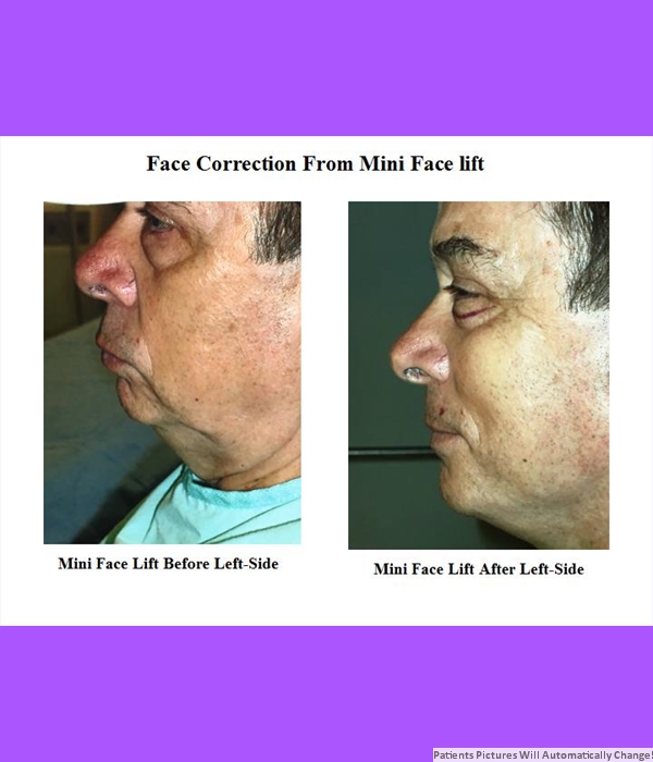 Face Correction From Mini Face Lift, Left Side View Cost is $3,200.00