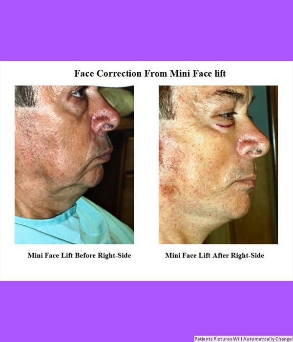 Correction Performed By Mini Face Lift, Right Side View Cost is $3,200.00