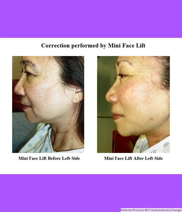 Correction Performed By Mini Face Lift, Left Side View Cost is $3,200.00