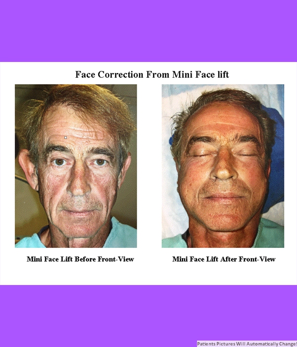 Correction Performed By Mini Face Lift, Front View Cost is $3,200.00
