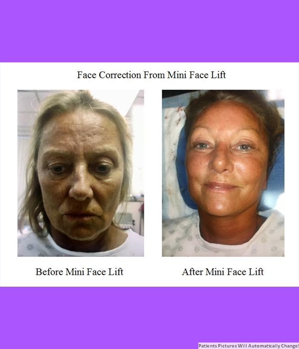 Correction Performed By Mini Face Lift, Front View Cost is $3,200.00