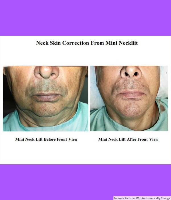 Neck Skin Correction From Mini Necklift, Front View Cost is $3,200.00