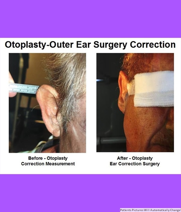 Patient Otoplasty-outer ear surgery correction Cost is $1500.00