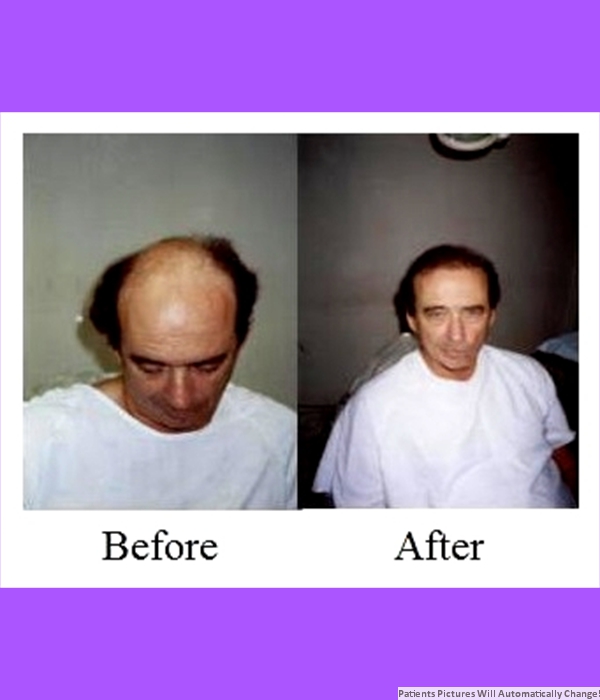  Patient Hair Transplant Cost is $3,800.00