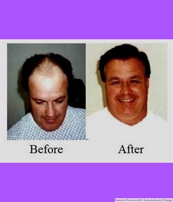  Patient  Hair Transplant Cost is $3,000.00