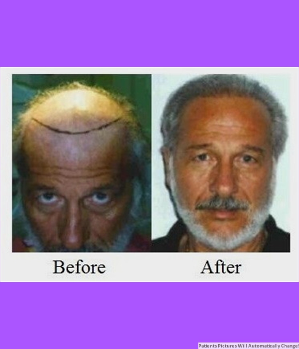  Patient Hair Transplant Cost is $4,500.00