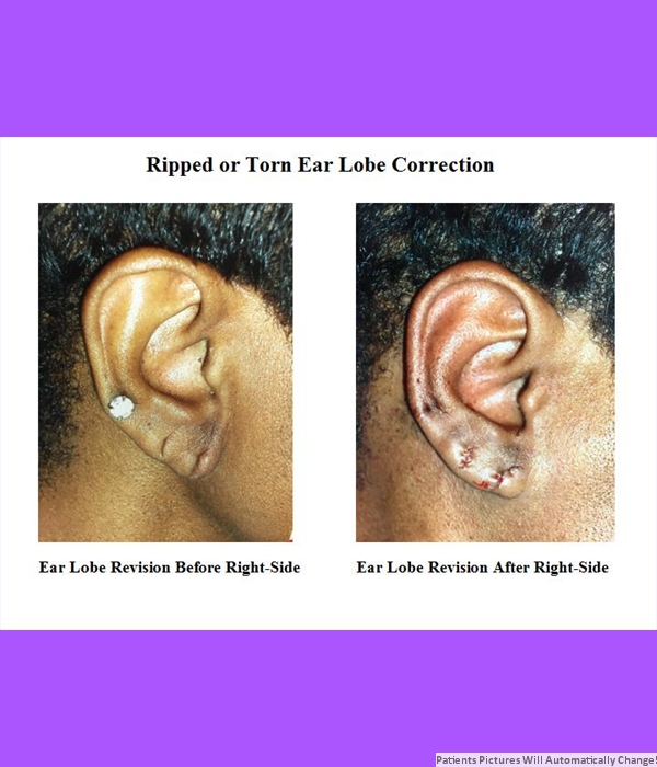 Ripped or Torn Ear Lobe Correction, Right-Side View Cost is $400.00 Per Side!